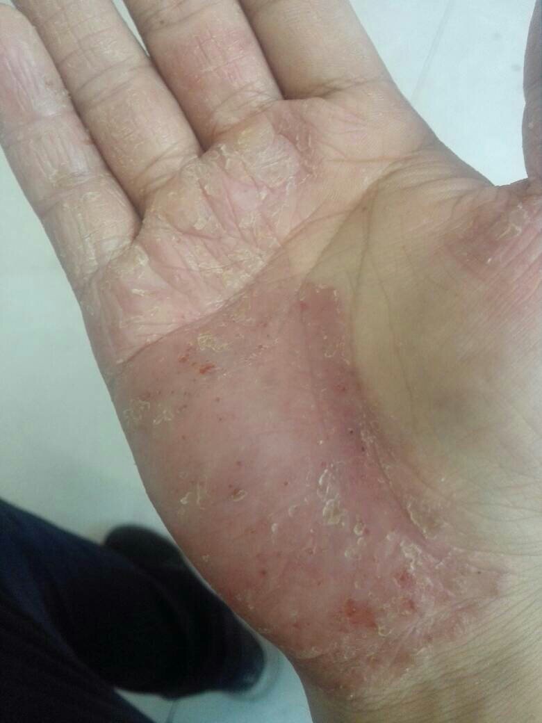 药物刺激皮肤蜕皮药物刺激皮肤蜕皮，成因、影响与应对策略