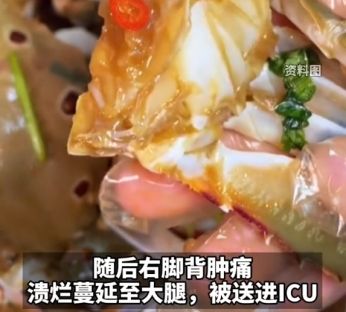 吃自制生腌蟹进ICU